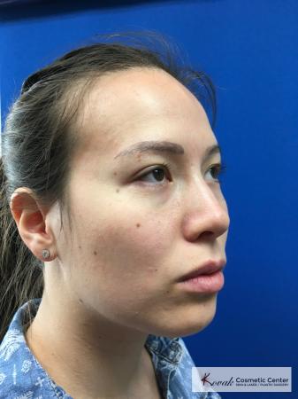 Restylane® Lyft: Patient 2 - Before and After 4