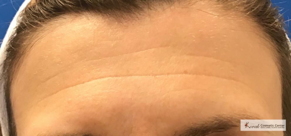 Restylane®: Patient 5 - Before 