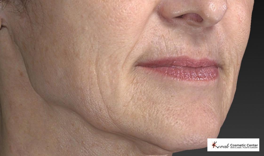 Restylane® Silk: Patient 2 - Before and After 5