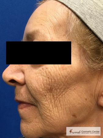Full Face Laser Skin Resurfacing on a 70 year old woman - Before Image 2