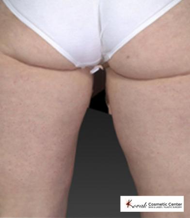 CoolSculpting®: Patient 16 - After 1