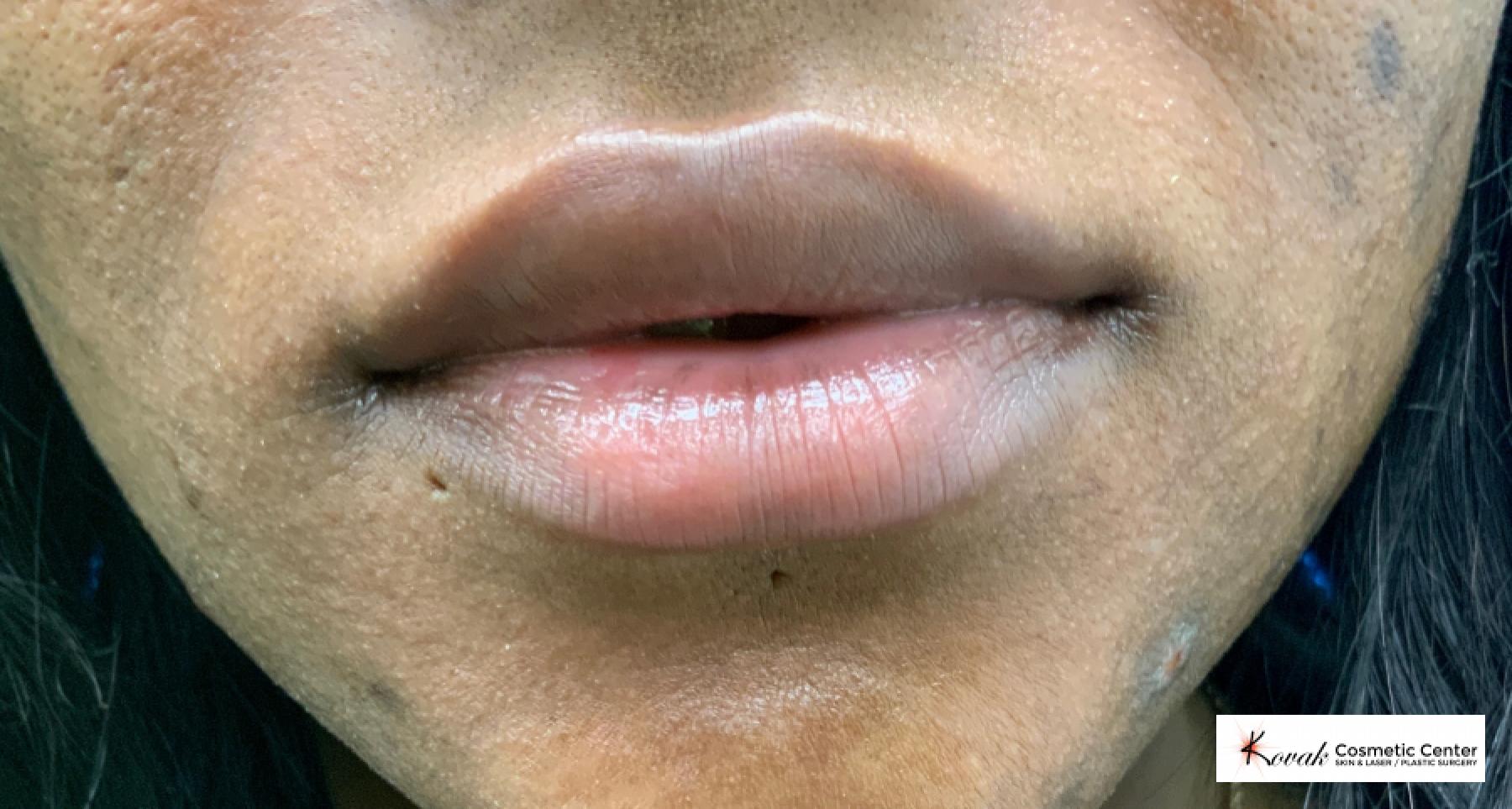 Lip filler using Juvederm on a 31 year old female - After  