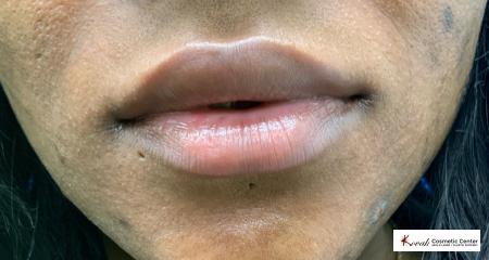 Lip filler using Juvederm on a 31 year old female - After 1
