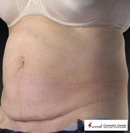 CoolSculpting®: Patient 8 - After 5