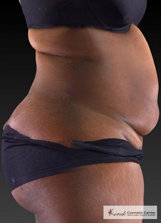 CoolSculpting®: Patient 23 - Before