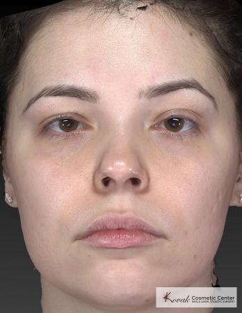 Venus Viva: Patient 4 - Before Image 4