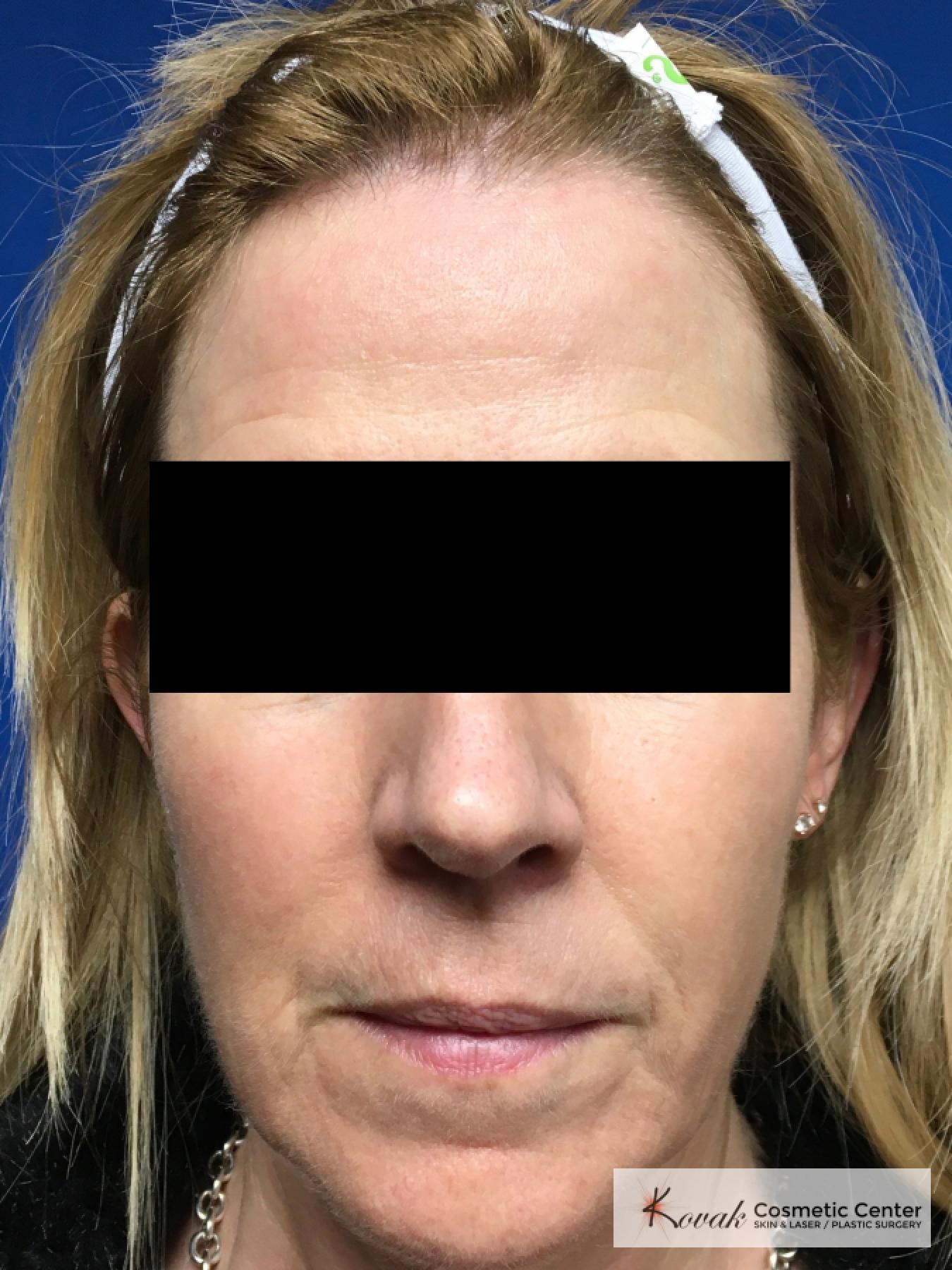 Sculptra Treatment on a 53 year old female patient - After  