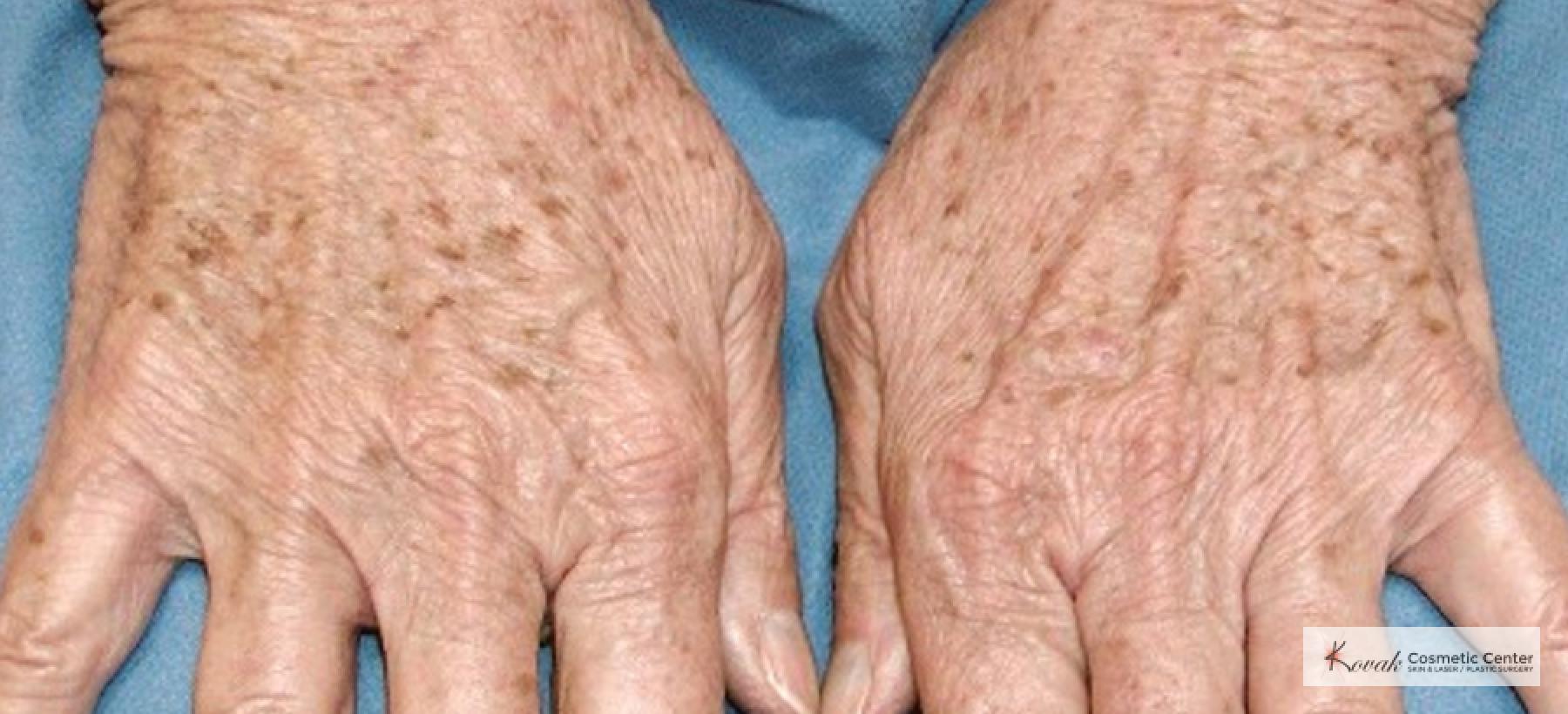 Tyte and Bryte Photorejuvenation on a 65 year old female - Before 