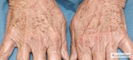 Tyte and Bryte Photorejuvenation on a 65 year old female - Before 1
