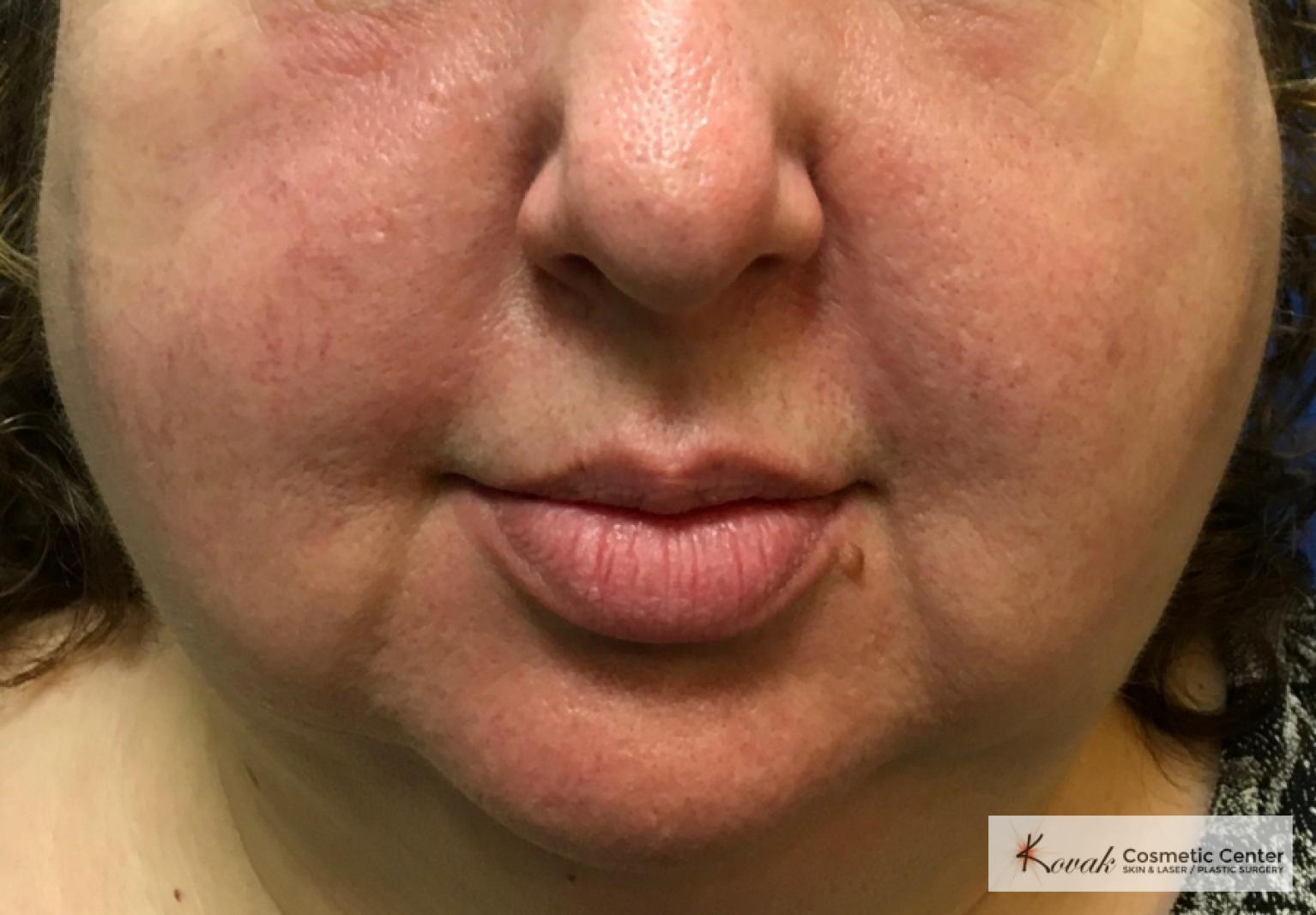 Laser Liposuction using the Vaser system of the jawline on a 52 year old female - Before 