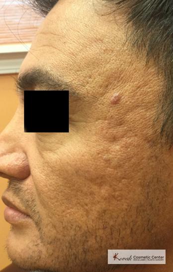 Juvéderm® XC: Patient 9 - Before 