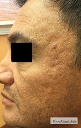 Juvéderm® XC: Patient 9 - Before 1