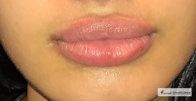 Restylane®: Patient 1 - After  