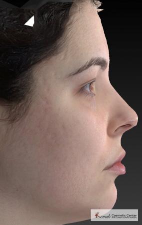 Venus Viva: Patient 4 - Before Image 2
