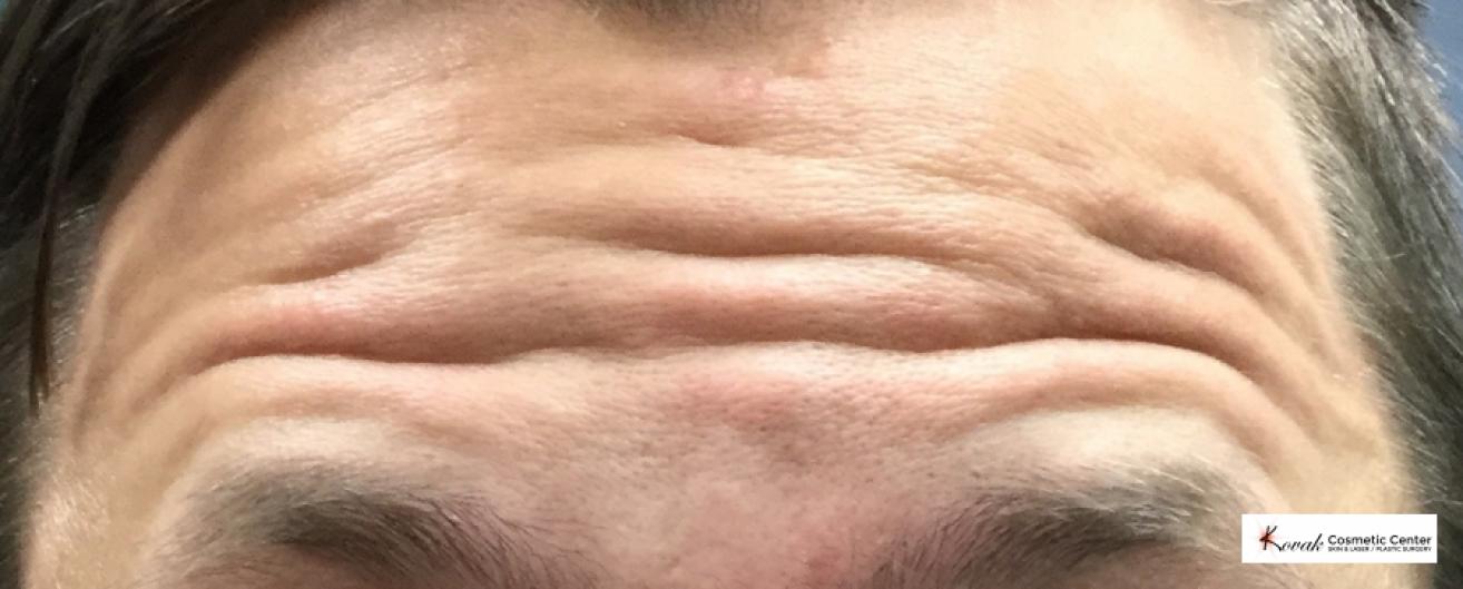Botox for the forehead on a 30 year old male - Before 