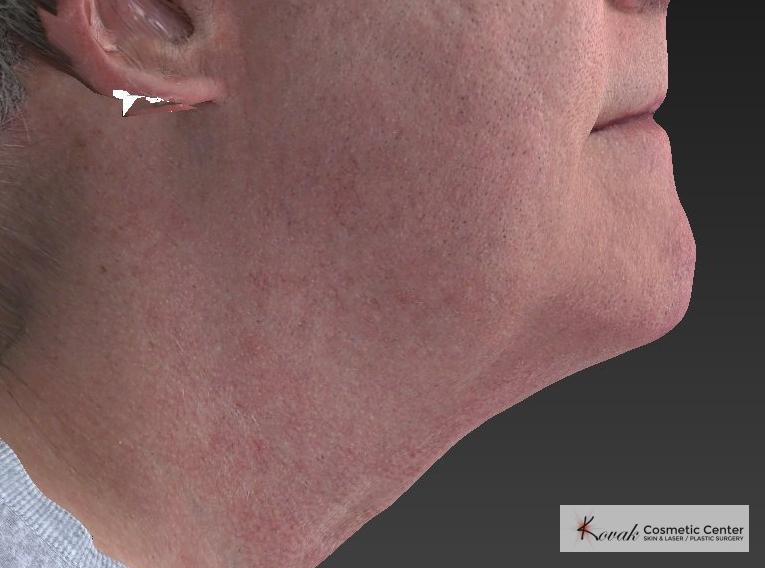 Kybella: Patient 4 - After  