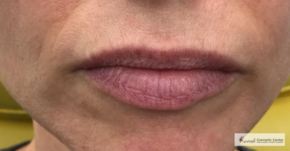 Restylane® Silk: Patient 9 - Before 