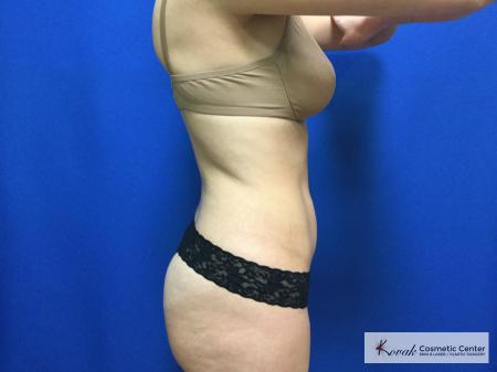CoolSculpting®: Patient 17 - After 3