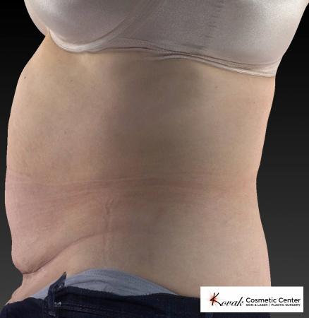 CoolSculpting®: Patient 8 - After 3