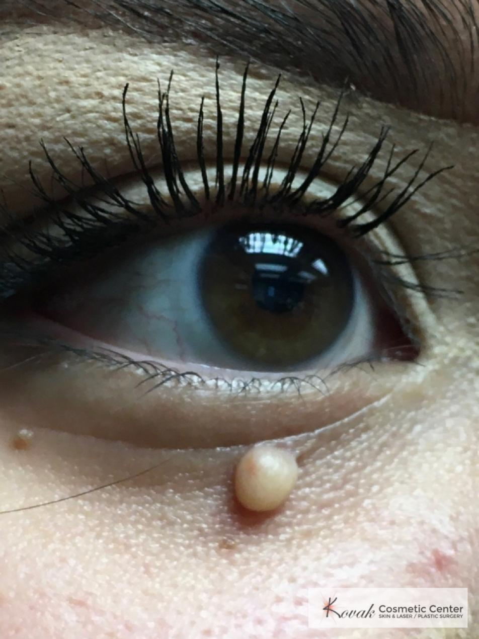 Mole Removal on 25 year old Female patient - Before 