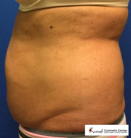 CoolSculpting®: Patient 1 - Before 3