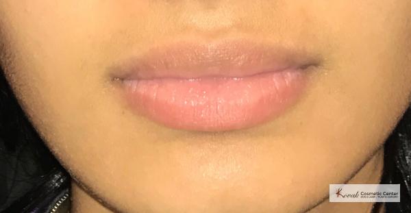 Restylane®: Patient 1 - Before 