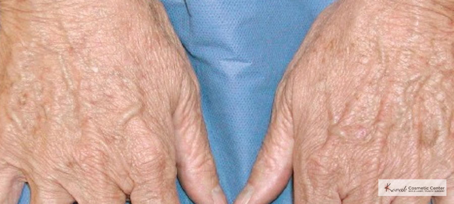 Tyte and Bryte Photorejuvenation on a 65 year old female - After  