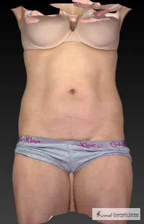 CoolSculpting®: Patient 22 - Before