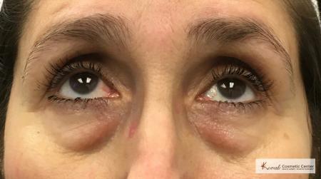 Restylane® Silk: Patient 11 - Before 1