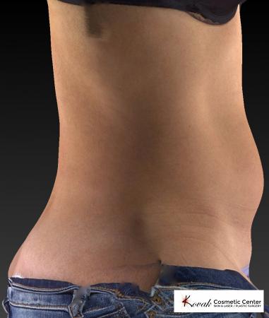 CoolSculpting®: Patient 6 - After Image 2