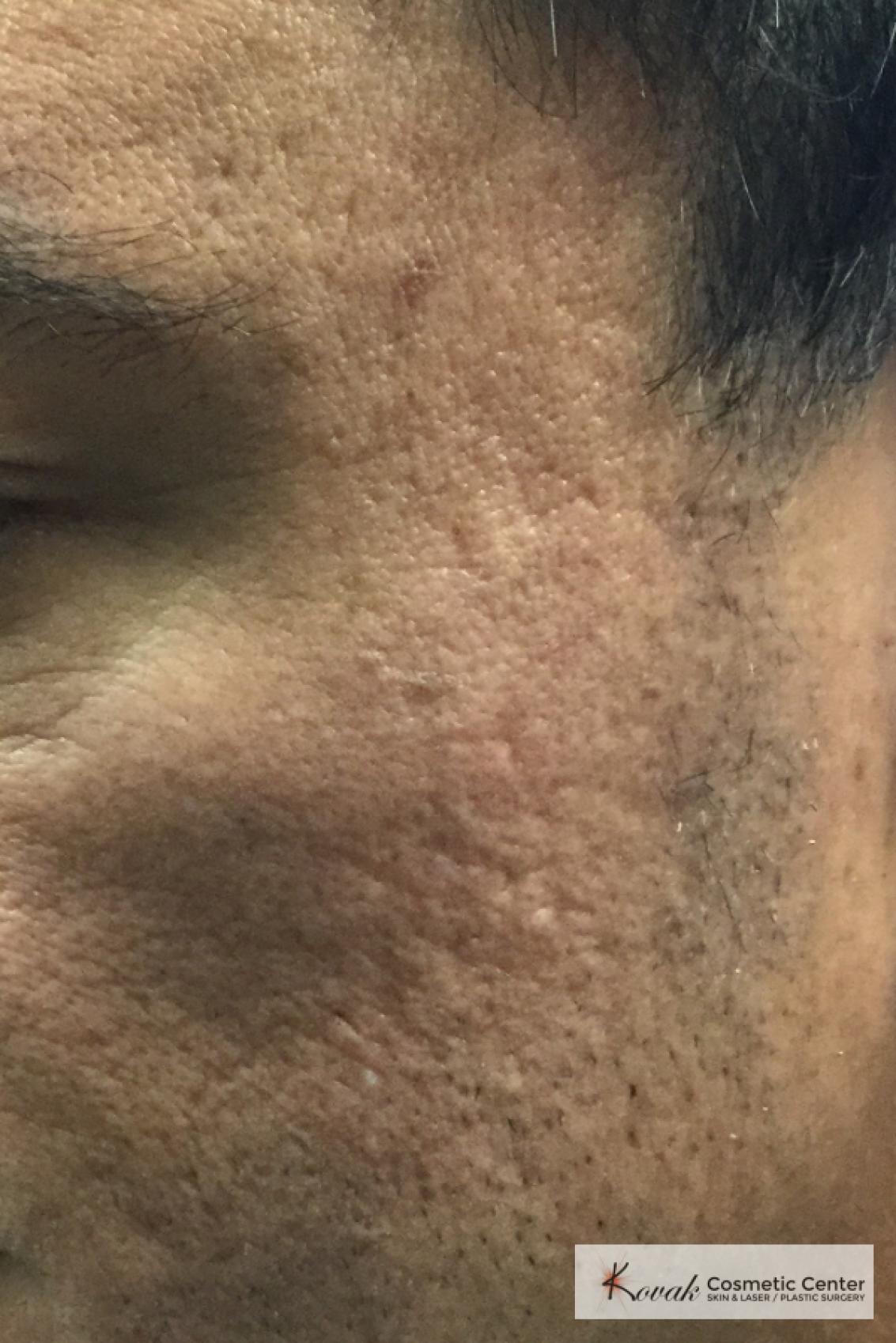 Acne Scars treated with Juvederm on 47 year old male - After  