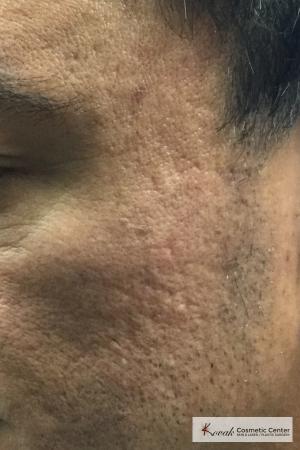Acne Scars treated with Juvederm on 47 year old male - After Image 1