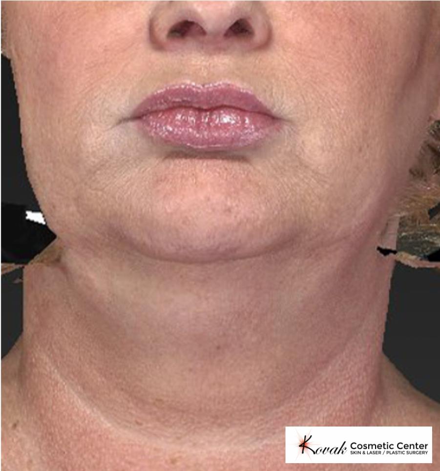 Kybella: Patient 1 - Before 