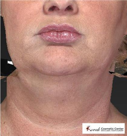 Kybella: Patient 1 - Before Image 1