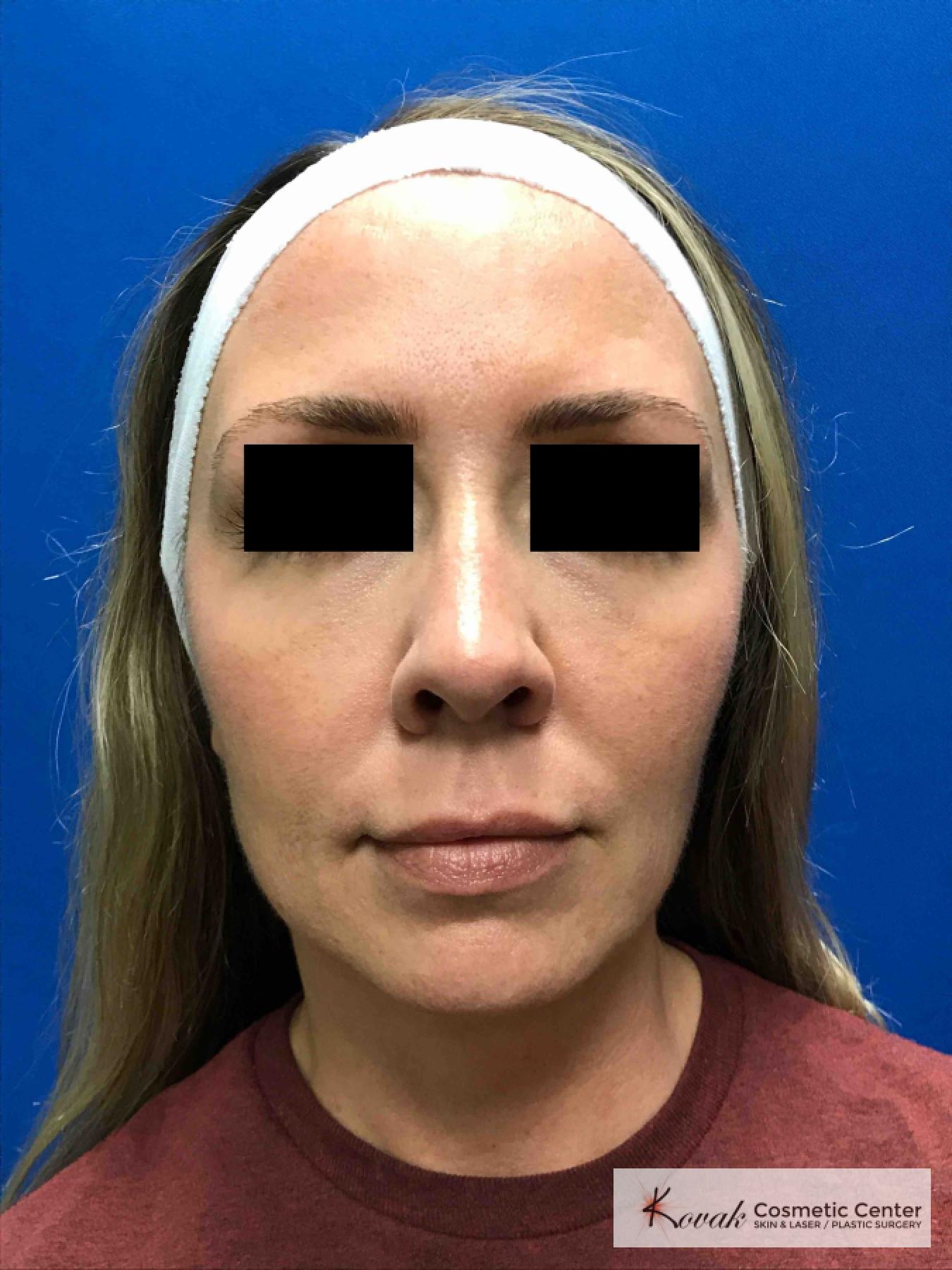 Injectables - Face: Patient 5 - After  