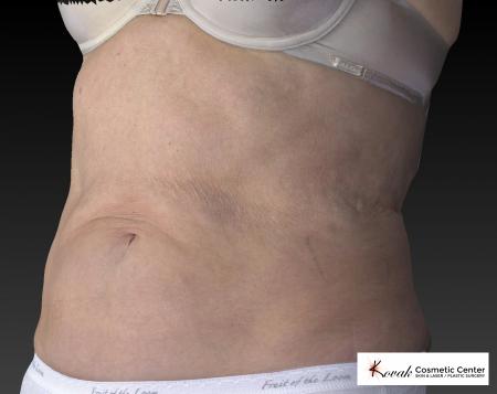CoolSculpting®: Patient 13 - After 1