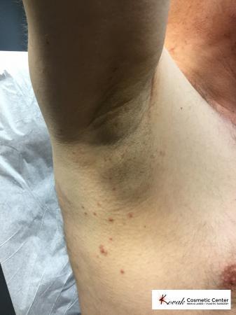 Lumps & Bumps: Patient 1 - After Image 1