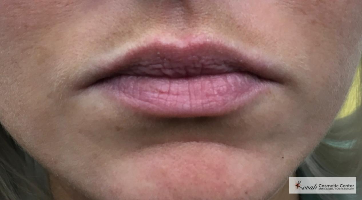 Injectables: Patient 5 - Before 