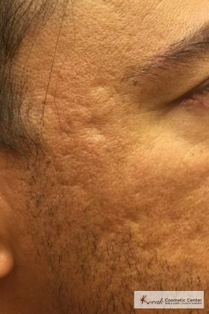 Acne Scars treated with Juvederm on 47 year old male - Before and After Image 2