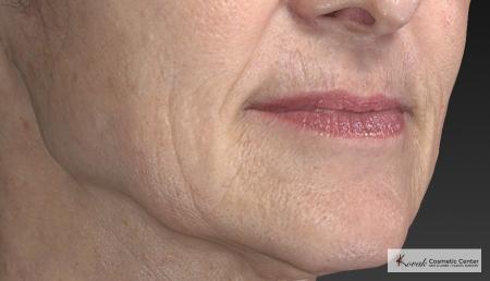 Injectables - Mouth: Patient 8 - Before and After Image 5