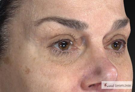 Laser Skin Resurfacing - Face: Patient 2 - Before and After Image 5