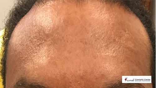 Restylane® Silk: Patient 7 - After  