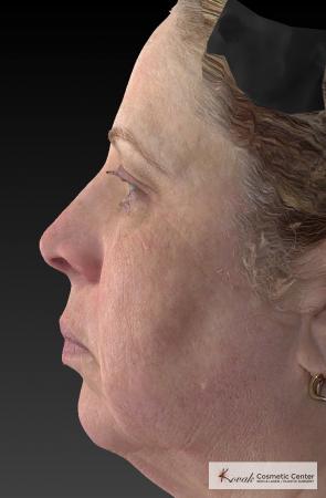 Tyte And Bryte – Face: Patient 3 - After Image 2