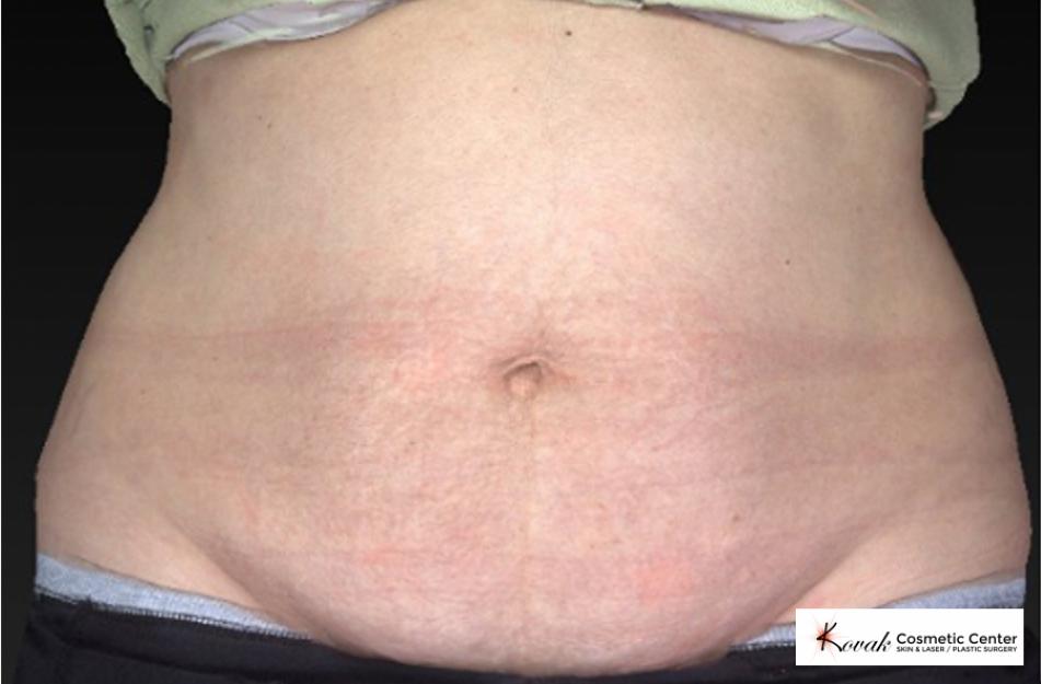 CoolSculpting Patient 101 - Before 