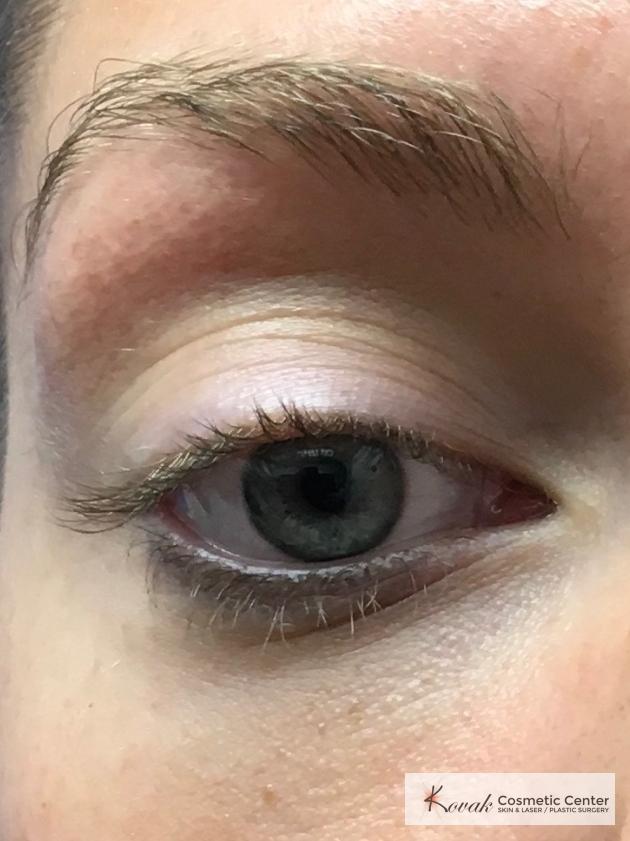 Dark Circle Treatment with Restylane Silk on a 29 year old female - After 1