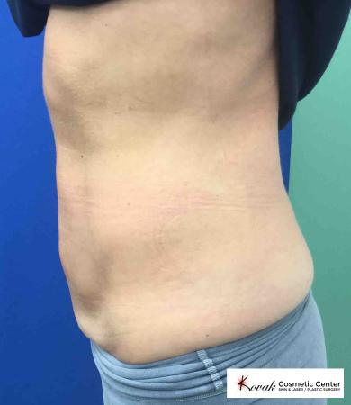 EMSCULPT®: Patient 2 - After 2