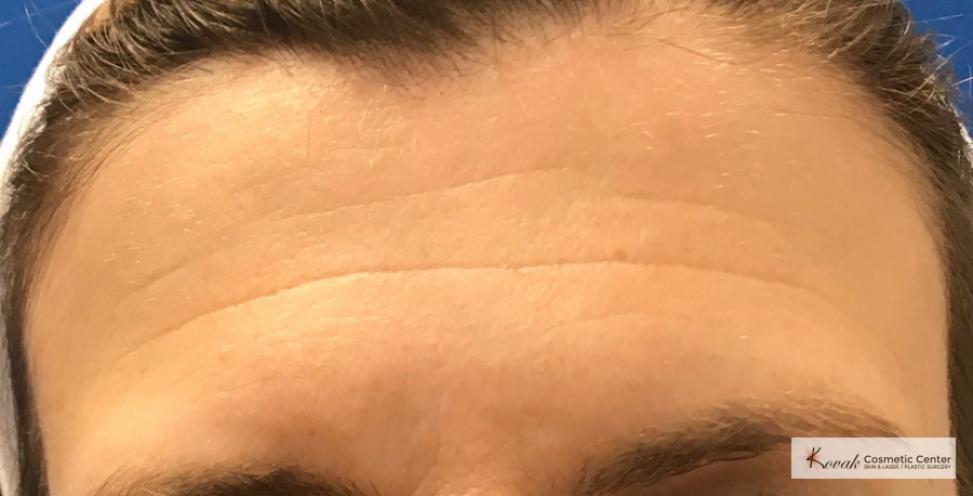 Injectables: Patient 3 - Before 