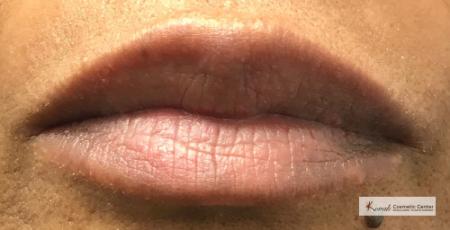Lumps & Bumps: Patient 2 - After Image 1