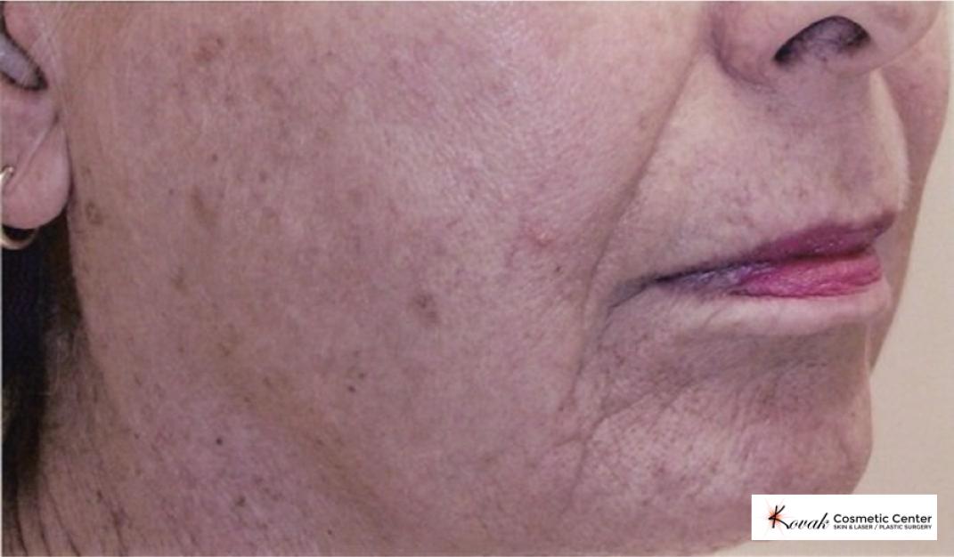 Tyte & Bryte Photorejuvenation on the face of a 57 year old female - Before 