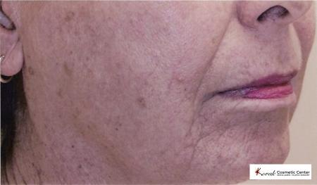 Tyte & Bryte Photorejuvenation on the face of a 57 year old female - Before 1